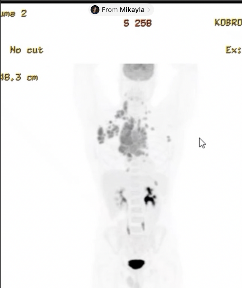 PET scan results