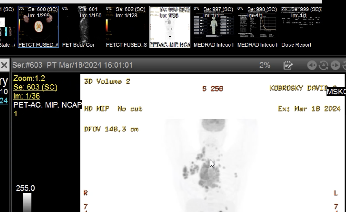 Tumor scan