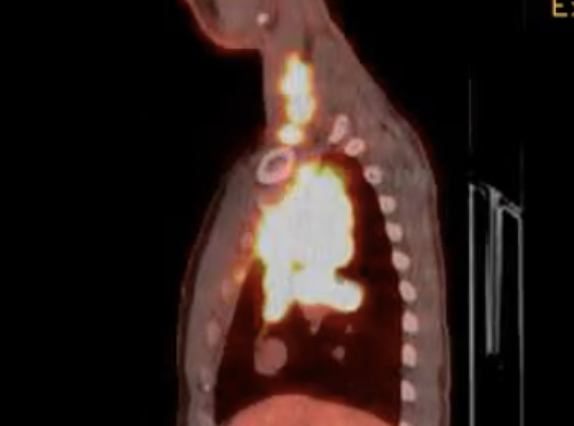 PET scan