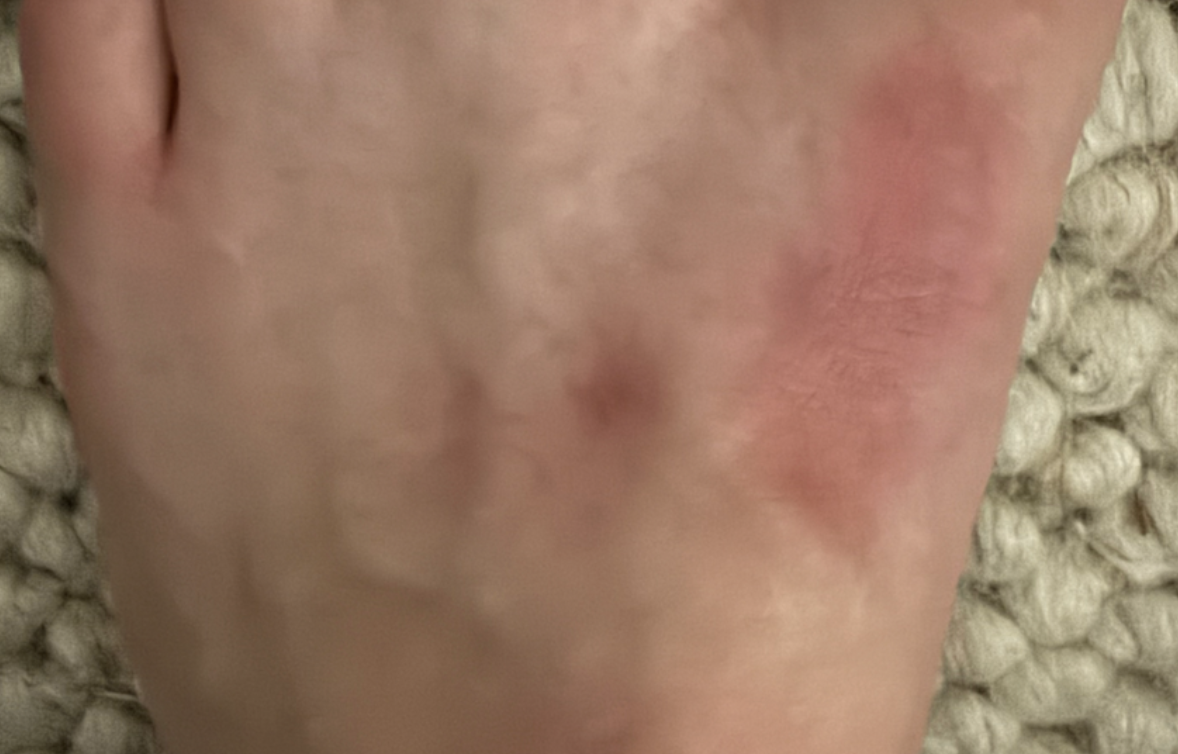 Healing scars on left foot from months of itching