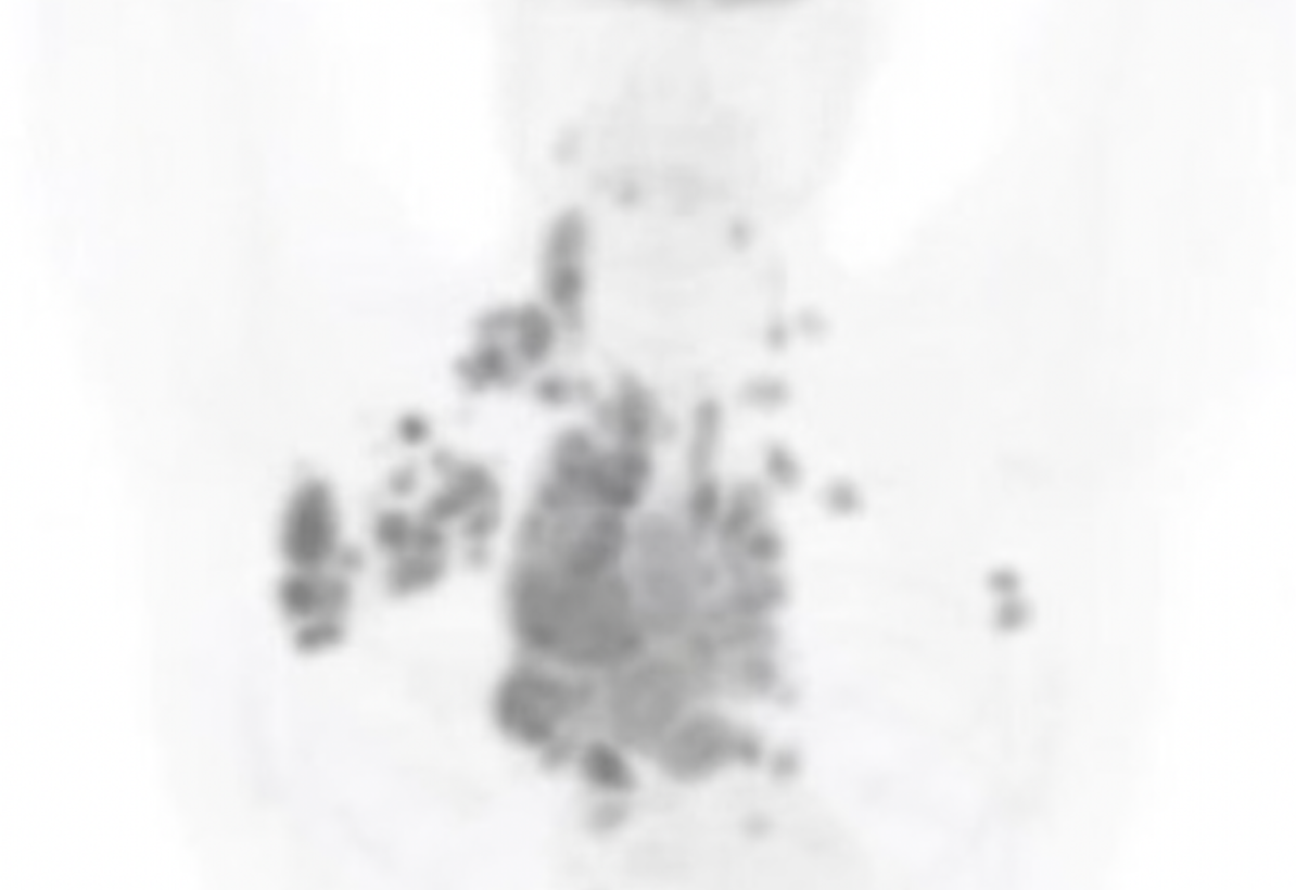 PET scan before treatment showing multiple tumors