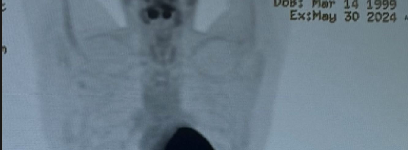 PET scan after treatment showing dramatic improvement