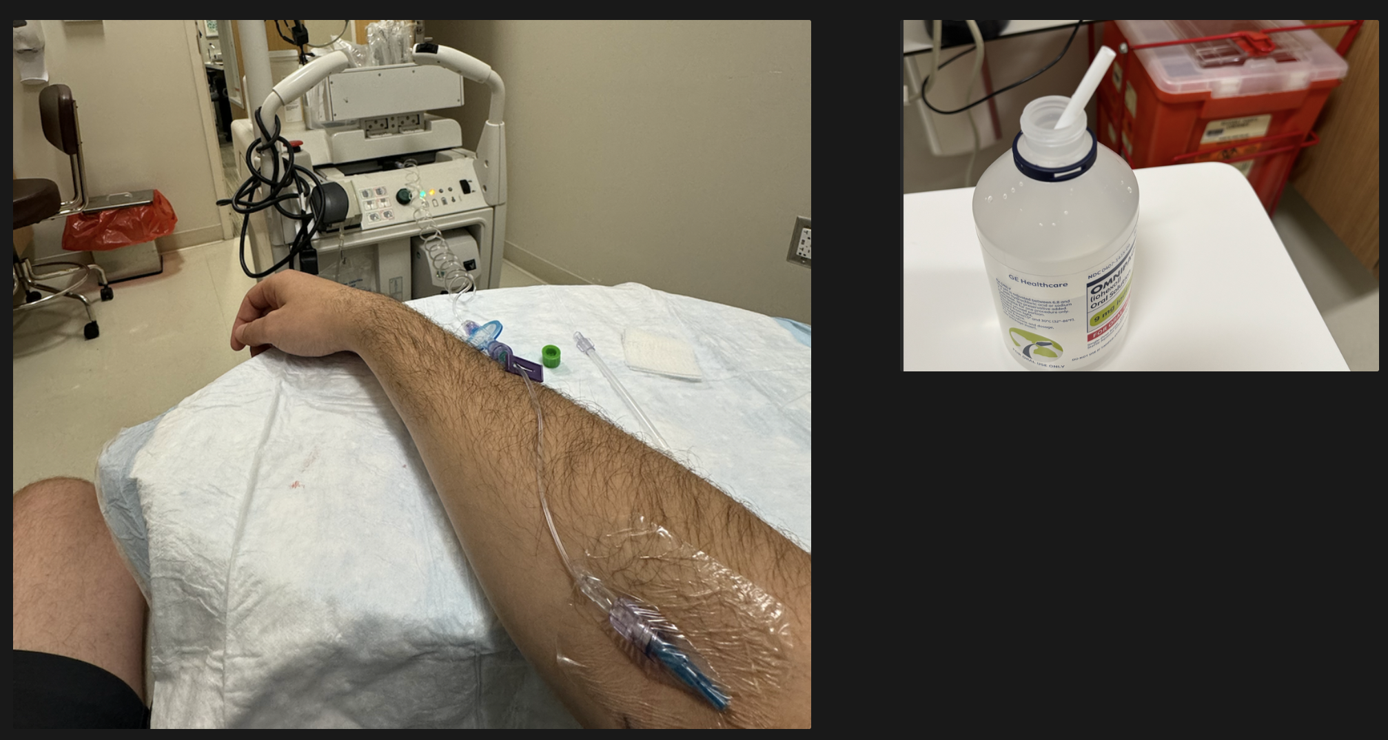 PET scan preparation with radioactive sugar injection