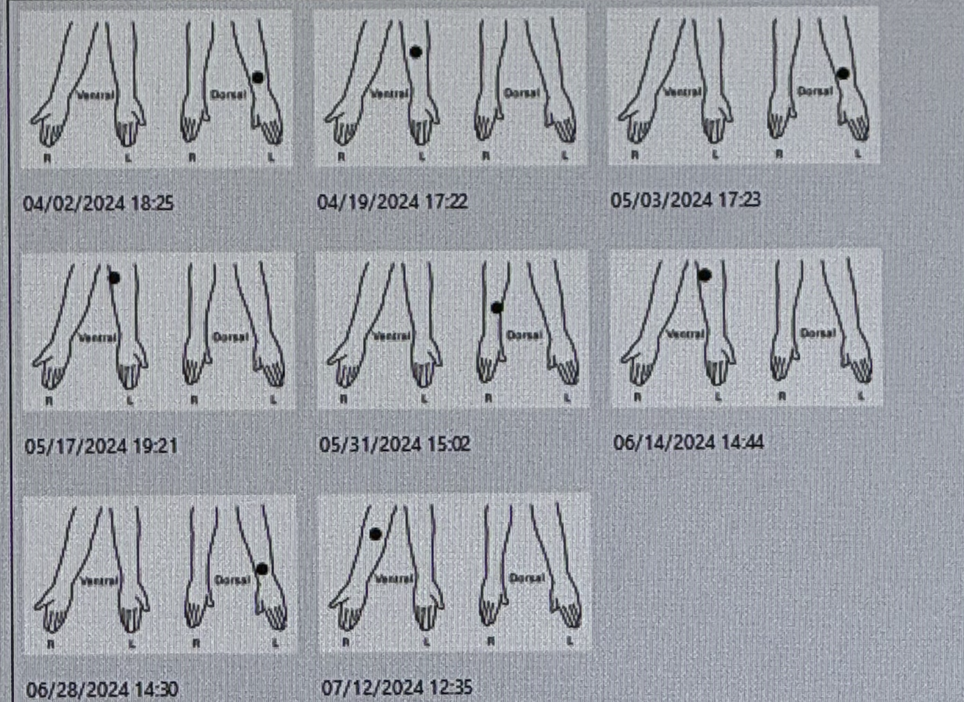 Nurse's chart tracking IV needle placement locations