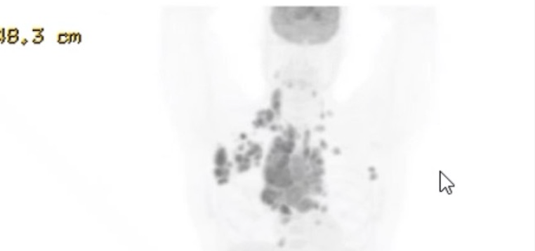 PET scan from 6 months ago showing multiple tumors throughout David's body