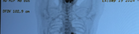 Recent PET scan showing David's body completely clear of cancer - in remission!