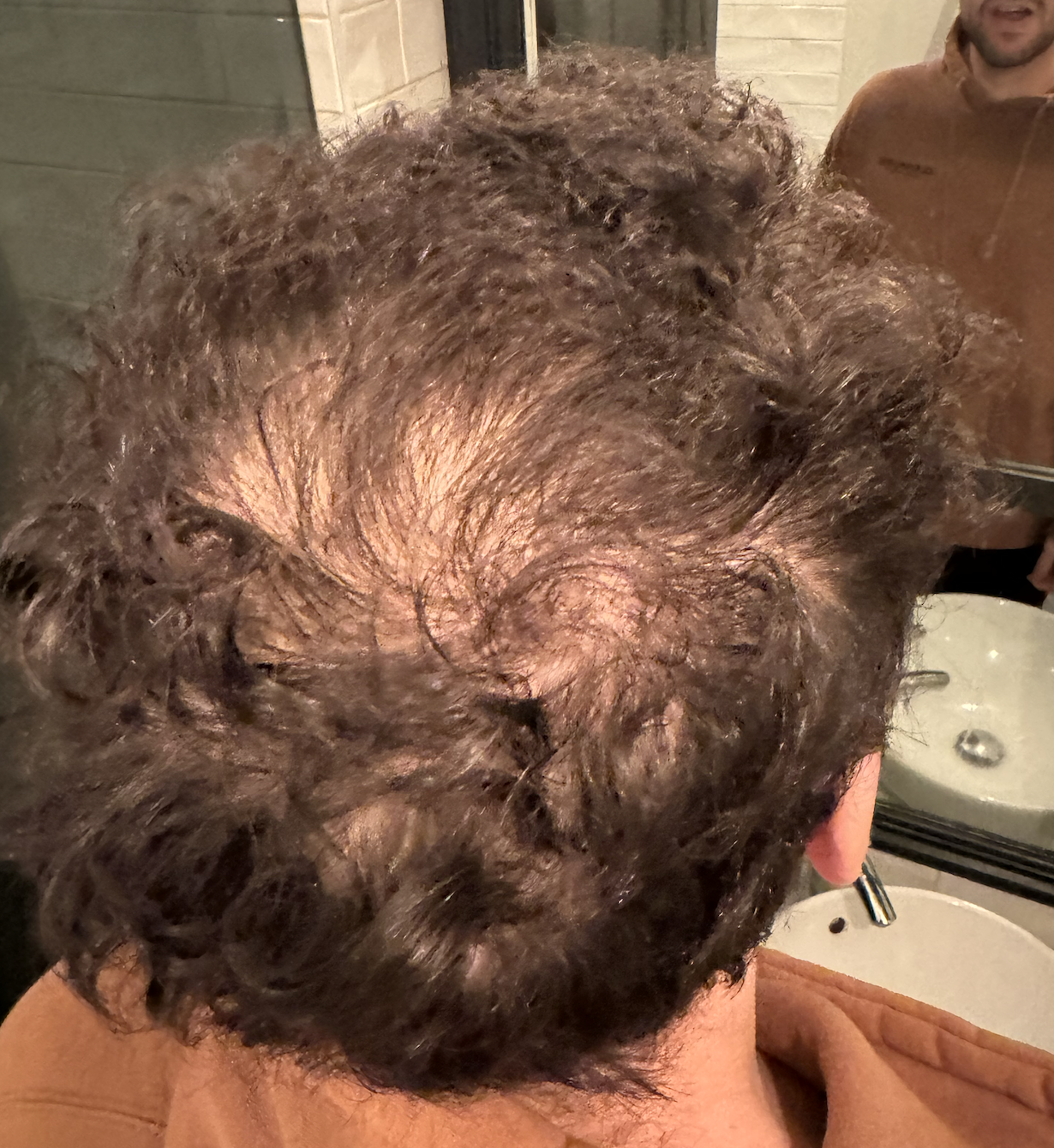 Hair loss progression