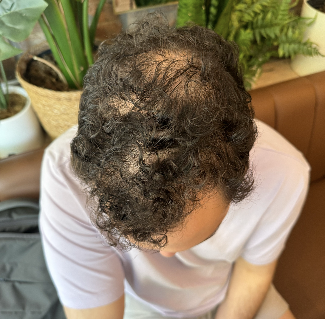 Hair loss progress photo