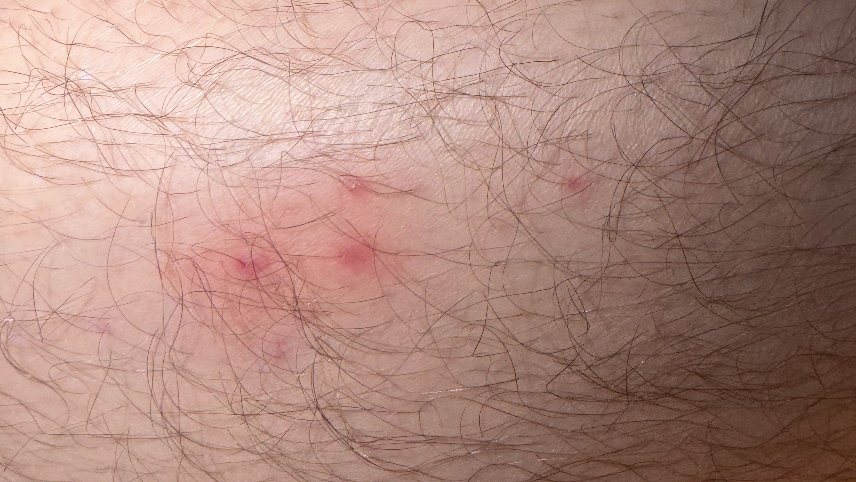 Small rash on skin